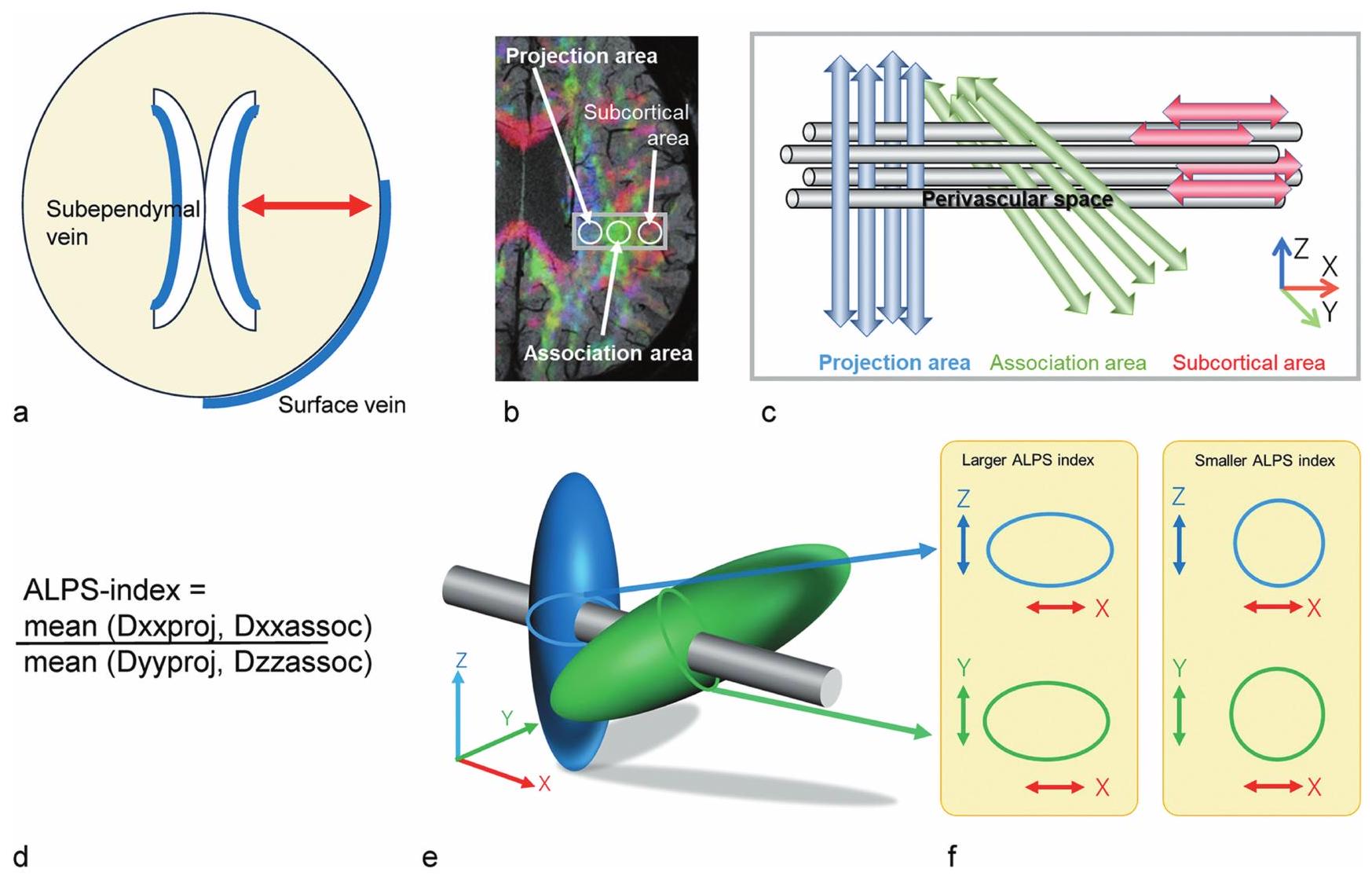 تحليل صور موتر الانتشار على طول الفضاء المحيط بالأوعية (DTI-ALPS): إعادة النظر في معنى وأهمية الطريقة Diffusion Tensor Image Analysis ALong the Perivascular Space (DTI-ALPS): Revisiting the Meaning and Significance of the Method