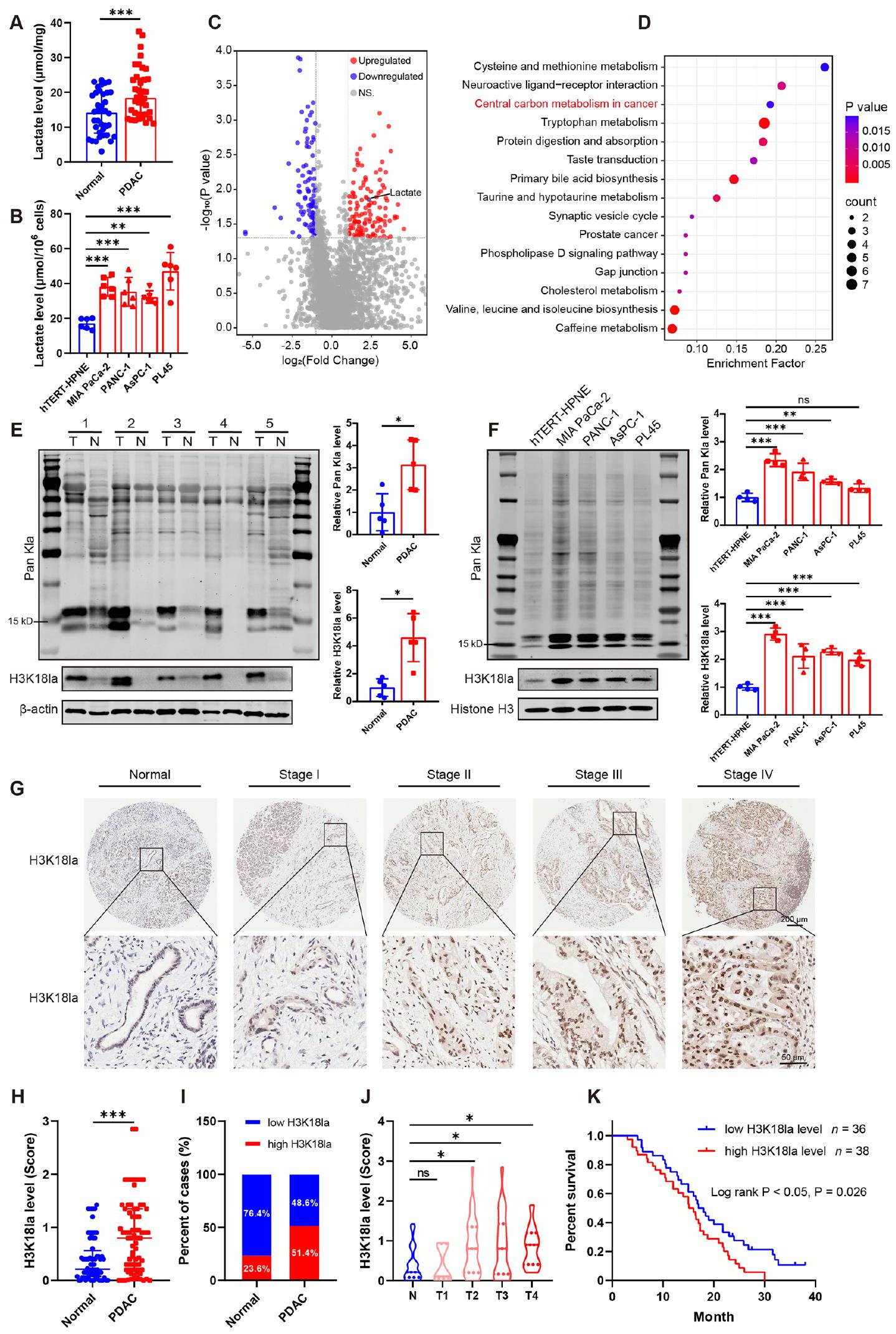 تنظيم التغذية الراجعة الإيجابية بين التحلل السكري والأسيتيل الهستوني يقود الأورام في سرطان القناة البنكرياسية الغدي Positive feedback regulation between glycolysis and histone lactylation drives oncogenesis in pancreatic ductal adenocarcinoma