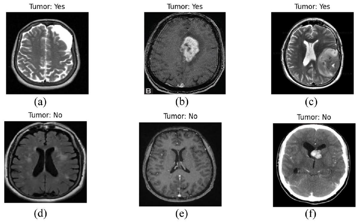 تعزيز اكتشاف أورام الدماغ في صور الرنين المغناطيسي من خلال الذكاء الاصطناعي القابل للتفسير باستخدام Grad-CAM مع Resnet 50 Enhancing brain tumor detection in MRI images through explainable AI using Grad-CAM with Resnet 50