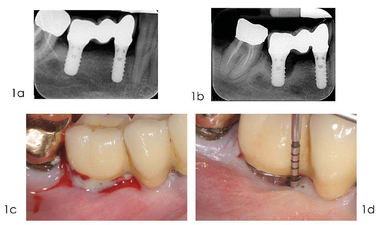 العلاج الجراحي لالتهاب المحيط بالزرع Surgical treatment of peri-implantitis