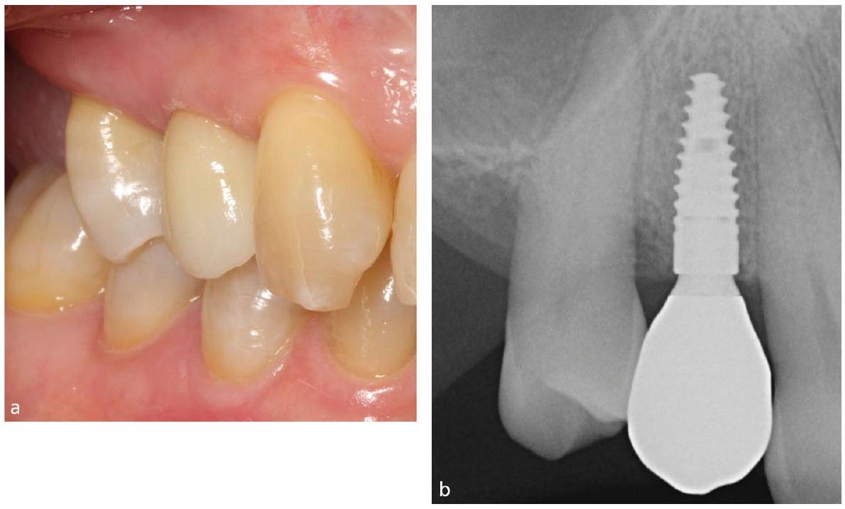 التهاب الغشاء المخاطي حول الزرع والتهاب الأنسجة المحيطة بالزرع: السمات الرئيسية والاختلافات Peri-implant mucositis and peri-implantitis: key features and differences