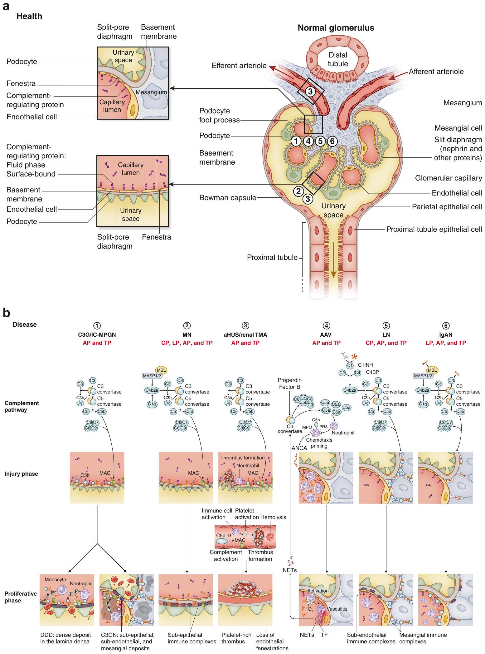 دور المكمل في أمراض الكلى: استنتاجات من مؤتمر جدل حول أمراض الكلى: تحسين النتائج العالمية (KDIGO) The role of complement in kidney disease: conclusions from a Kidney Disease: Improving Global Outcomes (KDIGO) Controversies Conference