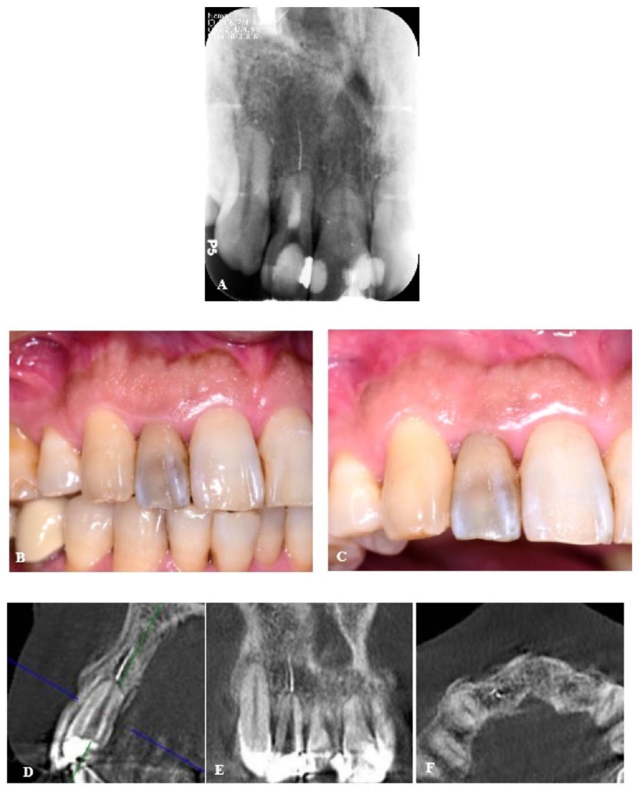 إزالة أداة مكسورة خارج الفتحة الذروية باستخدام جراحة الميكروسكوب السنية بمساعدة الروبوت: تقرير سريري Removal of a fractured file beyond the apical foramen using robot-assisted endodontic microsurgery: a clinical report