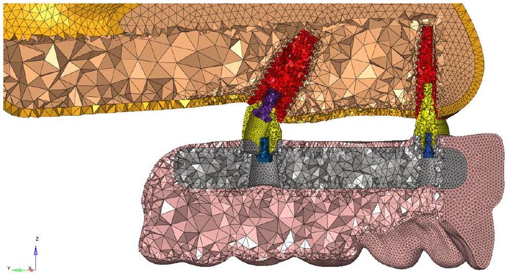 السلوك البيوميكانيكي لإطارات التيتانيوم، الكوبالت-الكروم، الزركونيا، وPEEK في الأطراف الاصطناعية المدعومة بالزرعات: تحليل ديناميكي للعناصر المحدودة Biomechanical behavior of titanium, cobalt-chromium, zirconia, and PEEK frameworks in implant-supported prostheses: a dynamic finite element analysis