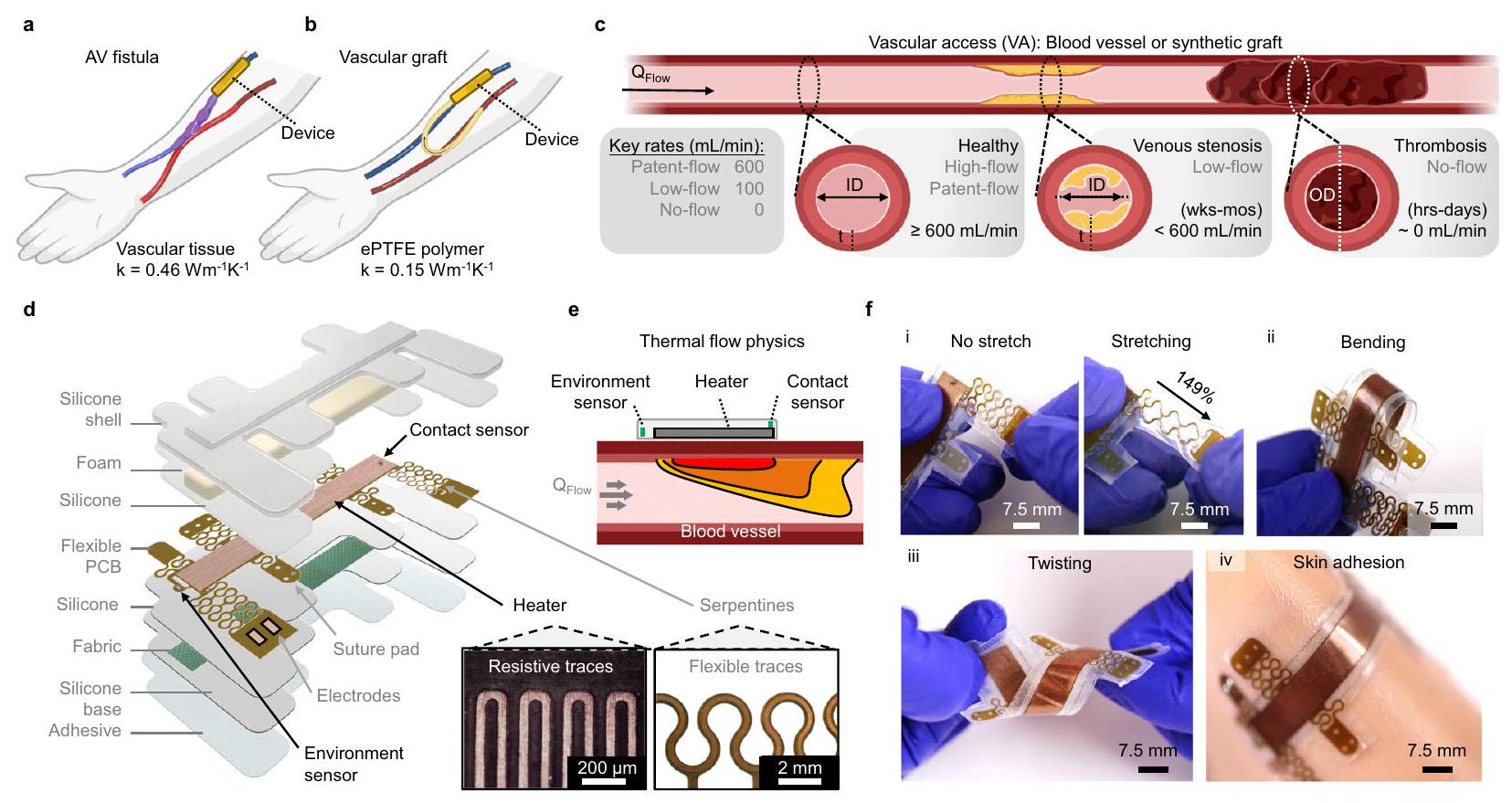 مستشعر حراري ناعم للتقييم المستمر لتدفق الوصول الوعائي A soft thermal sensor for the continuous assessment of flow in vascular access