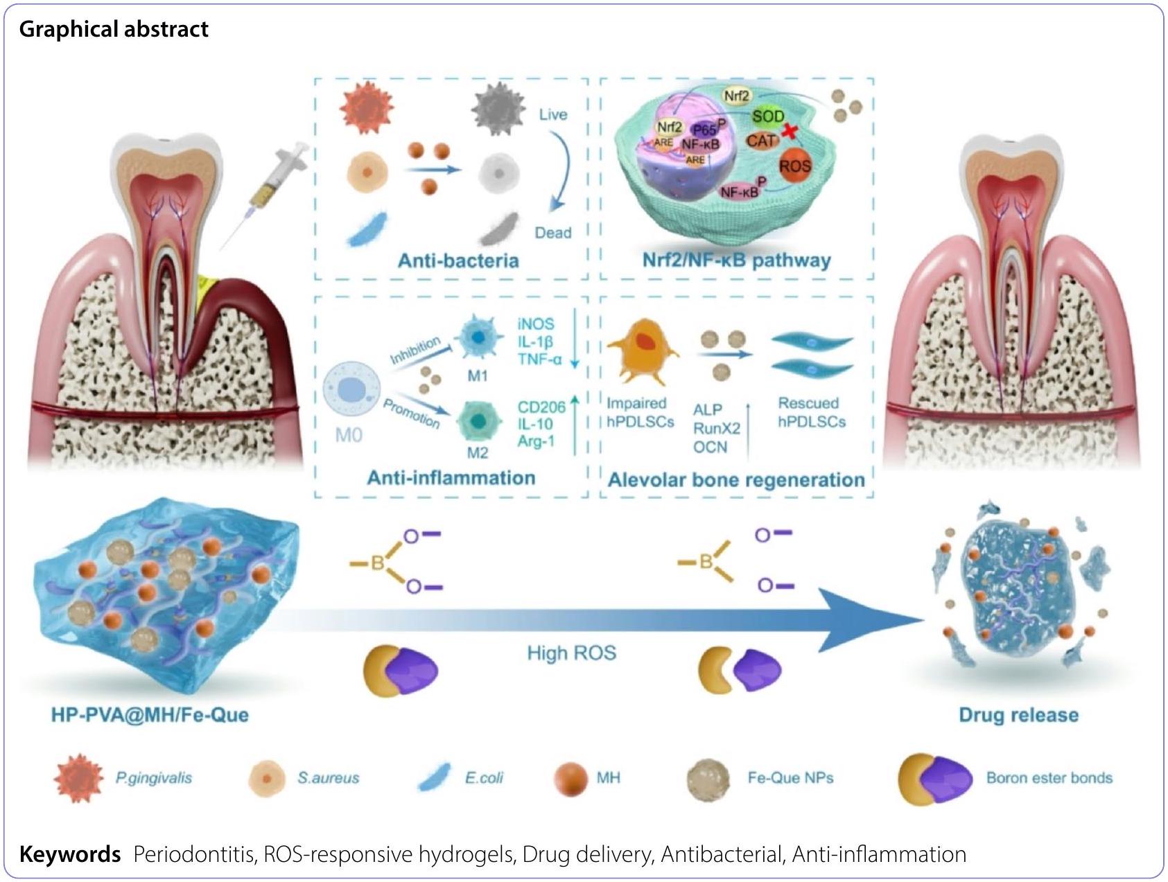 الهيدروجيل القابل للحقن مع إطلاق الدواء المحفز بواسطة أنواع الأكسجين التفاعلية يمكّن من التوصيل المشترك لعامل مضاد للبكتيريا وجزيئات نانوية مضادة للالتهابات لعلاج التهاب اللثة Injectable hydrogels with ROS-triggered drug release enable the co-delivery of antibacterial agent and anti-inflammatory nanoparticle for periodontitis treatment